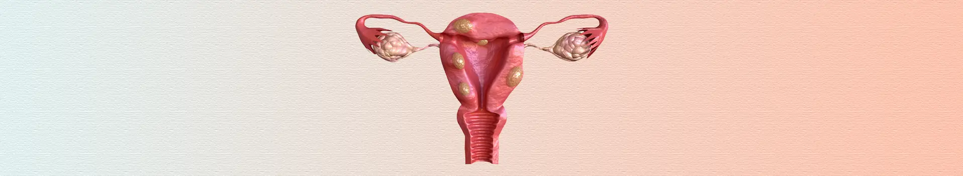 Illustration showing uterine fibroids