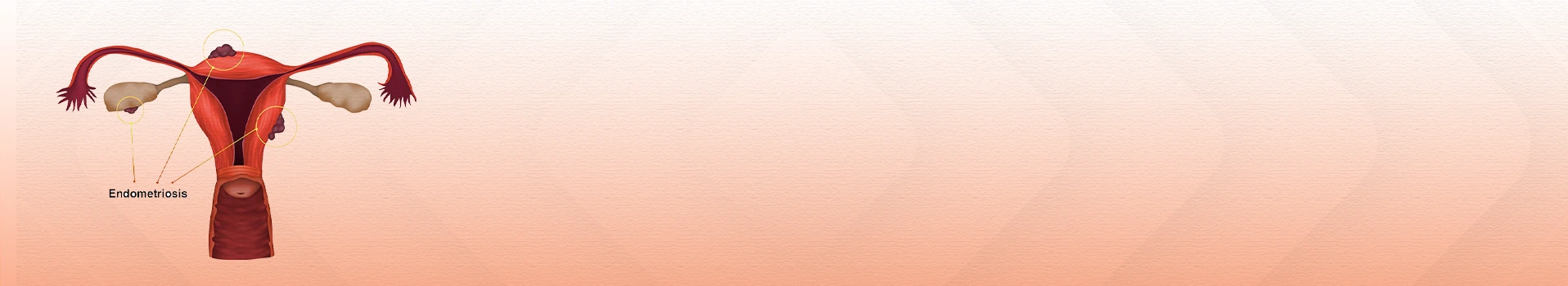 Endometriosis illustration